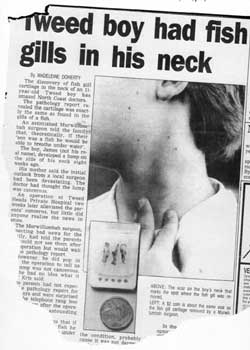 Tweed boy had fish gills in his neck - Newspaper clipping