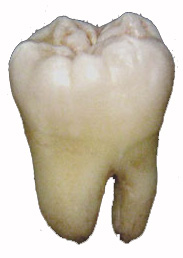 Wisdom tooth