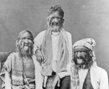 Three generations of the Mandalay family suffered from what could have been Congenital hypertrichosis universalis (human werewolf syndrome)